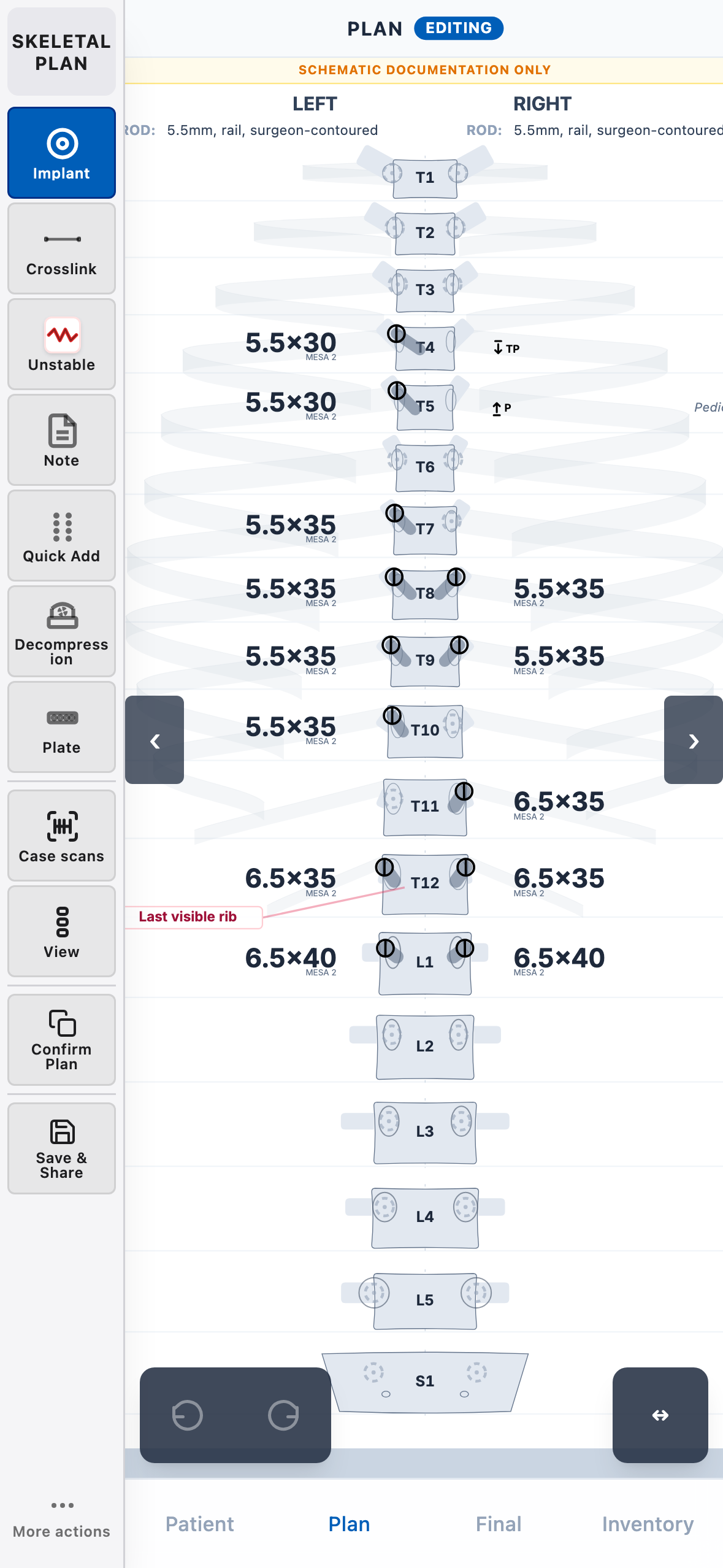 Skeletal Plan on iPhone: a scoliosis instrumentation plan