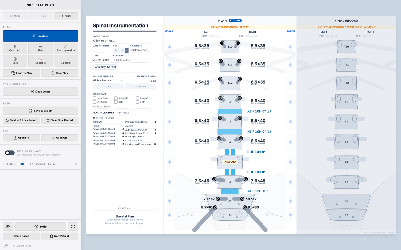 Skeletal Plan on a desktop monitor: a pedicle subtraction osteotomy plan with the operative record and a live implant inventory
